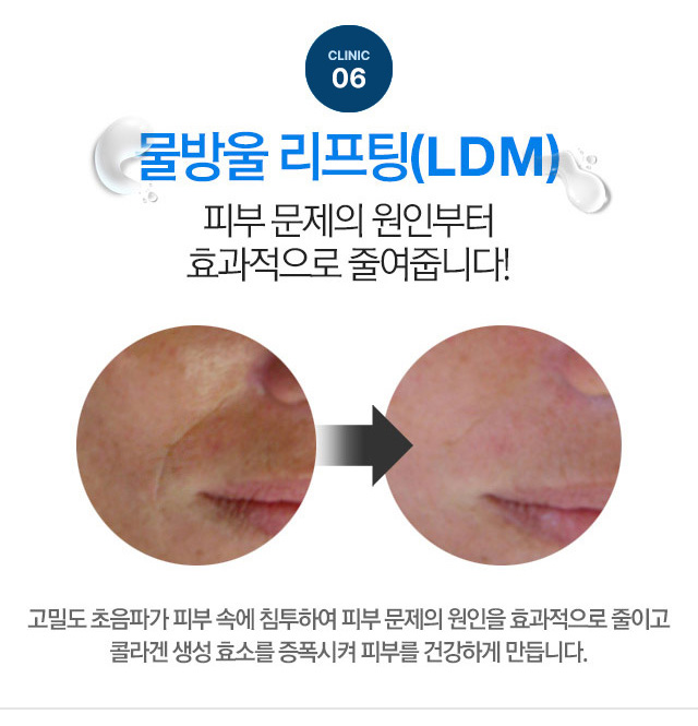 물방울 리프팅(LDM) 피부 문제의 원인부터 효과적으로 줄여줍니다!